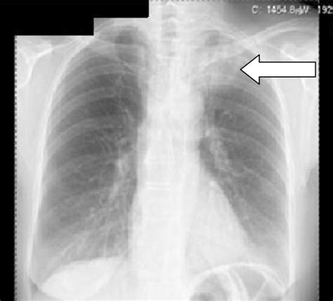 Example Of Grade 3 Rp In The Apical Lateral Region Of The Left Lung On