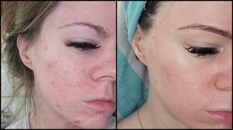 15 Years Of Taking Skin Care Seriously 31f Acne Prone Oily Skin
