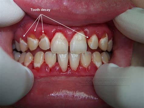 Tooth Decay Ask Your Dentist