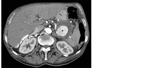 Contrast Enhanced Ct Scan Showing A Pancreatic Pseudocyst With A