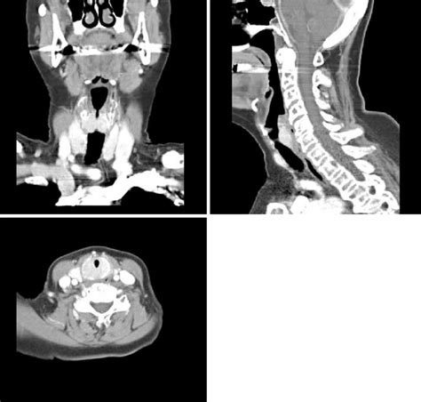 Case 1 Ct Scan Neck Sagital Coronal And Axial Views Show A Subglottic