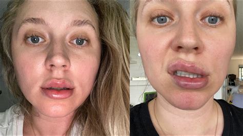 I Got Lip Filler This Is What Happened Before After Youtube