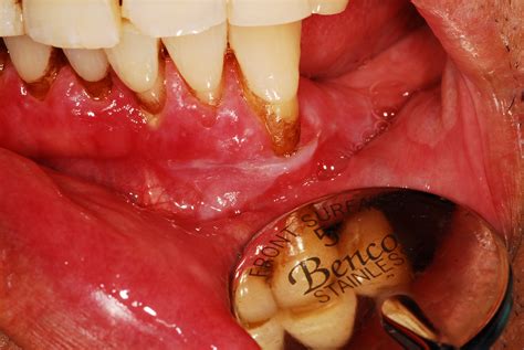 What does a bone spur look like? Oral Cancer - What does oral cancer look like