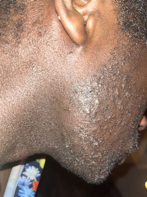 Possible OTC solutions : r/Fungalacne