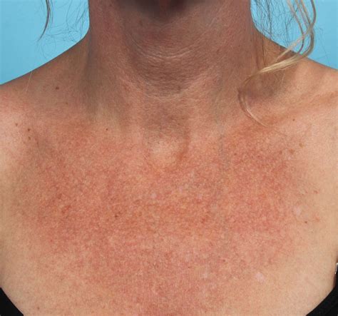 A 52 Year Old Female With Redness And Sun Damage Improvement On Her Chest