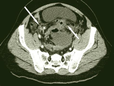 Ct Scan Showing A Necrotic Appendix With A Stercolith Long Arrow And