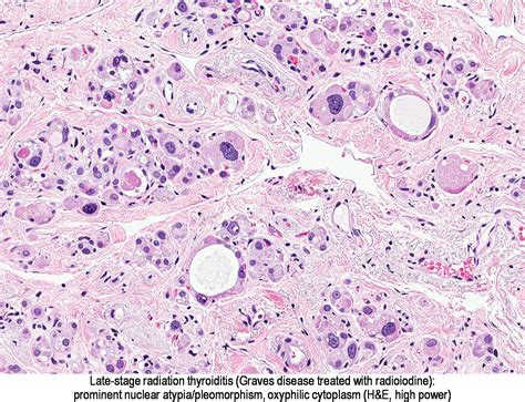 Pathology Outlines Graves Disease