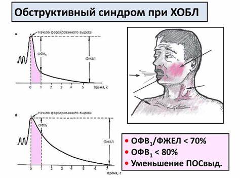 Хронический бронхит и диеты Хронический бронхит и ХОБЛ - презентация онлайн Хронический бронхит и ХОБЛ - презентация онлайн Хронический бронхит и диеты
