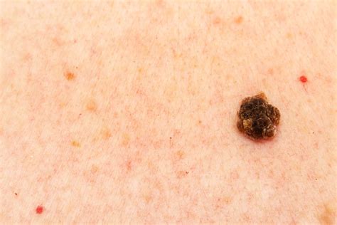 Understanding Seborrheic Keratosis Causes Treatment And Prevention Archyde