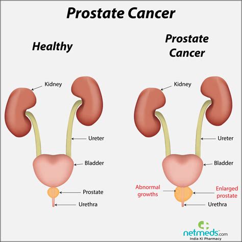 Prostate Cancer Causes Symptoms And Treatment Netmeds Sexiz Pix