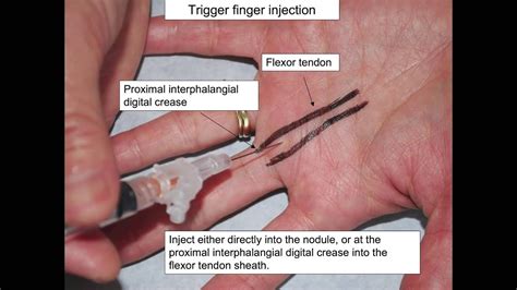 3 troubleshooting complications and differentiating other conditions. SdMskProject Trigger Finger - YouTube