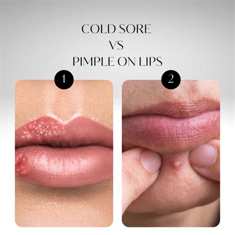 Cold Sore Vs Pimple On Lips 4 Absolute Differences And Treatment Shalinitalks