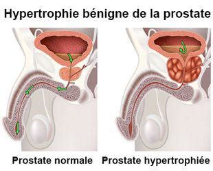 Hypertrophie B Nigne De Prostate Nucl Ation Laser H O L E P
