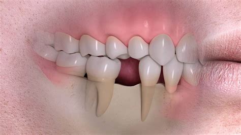 Jaw Bone Loss And Deterioration Dental Associates Of Arlington