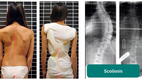 Scoliosis Physical Exam