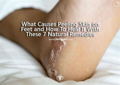 what causes peeling skin on feet and how to heal it with these 7 natural remedies peeling skin