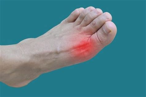 Joint Pain And Swelling Common Signs Of Gout Woodside Clinic