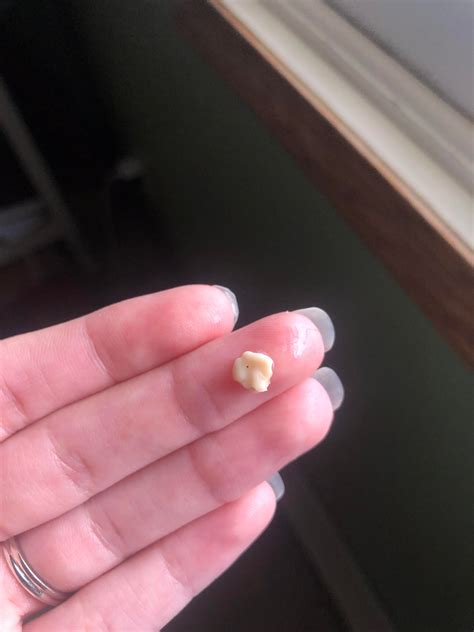 My First Tonsil Stone Ever Popped Out After A Sneeze Todayand Its A