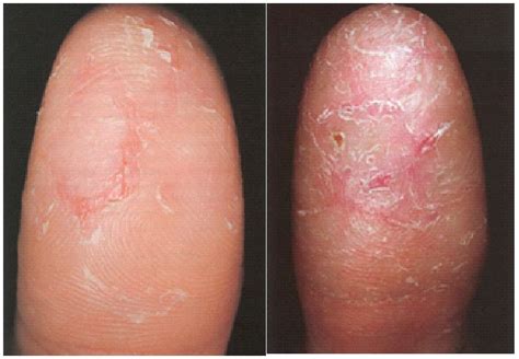 The most common part that peels off is the bottom of feet, which may also feel dry. Finger Eczema Causes | Dorothee Padraig South West Skin ...