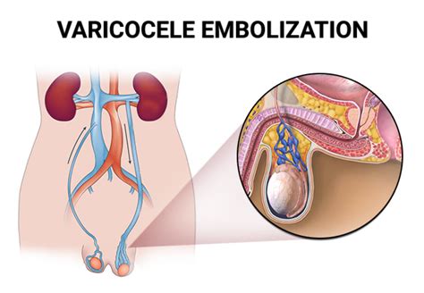 Varicocele Embolization Vein Endovascular Medical Care