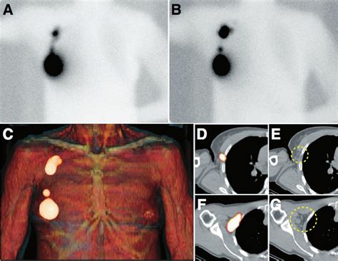 —planar Early A And Delayed B Lymphoscintigraphy As Well As Volume