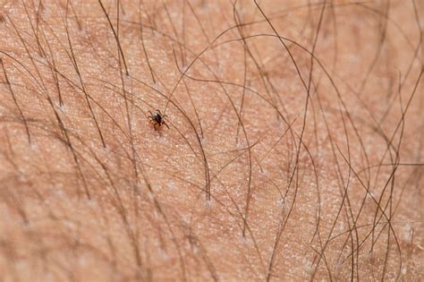 Tick Crawling On Hairy Human Skin Stock Photo Download Image Now
