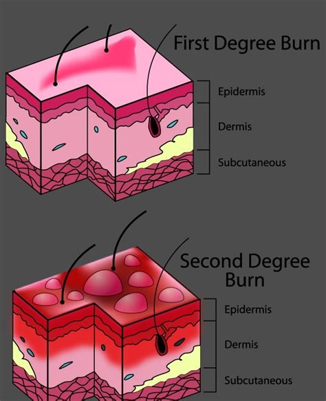 Burn Wound Care Diagram
