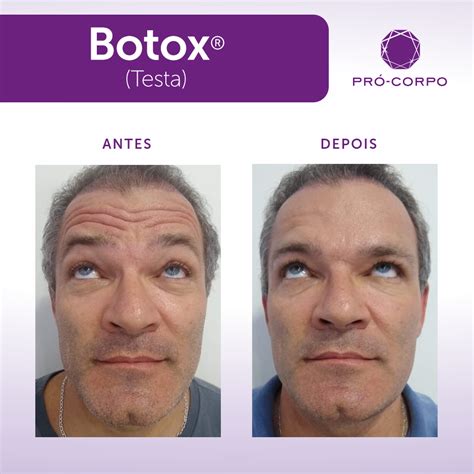 Botox Toxina Botul Nica Para Rugas E Linhas De Express O