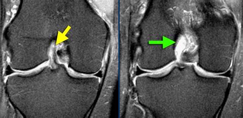 Partial Anterior Cruciate Ligament Acl Tears