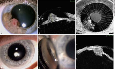 Figure 2 From Novel Eye Plaque Designs For Brachytherapy Of Iris And