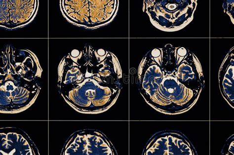 Imagem De MRI Do Close up Do Cérebro Humano Foto de Stock Imagem de autismo parkinson