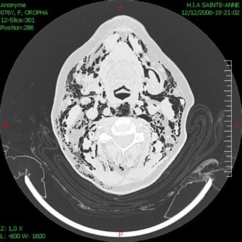 Thoracic Ct Showing Diffuse Soft Tissues Emphysema Of The Neck