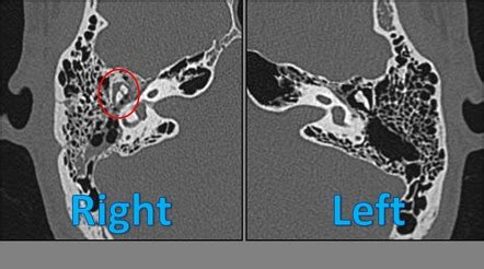 Longitudinal Temporal Bone Fracture Image Radiopaedia Org
