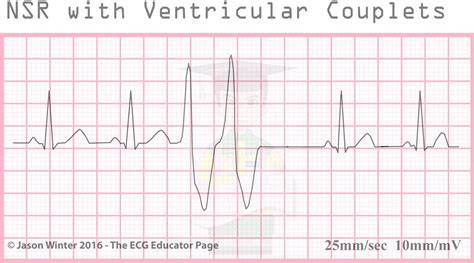 Ecg Educator Blog Ventricular Ectopics