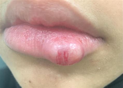 Cureus Unusual Lower Lip Swelling A Rare Case Of Lip Schwannoma
