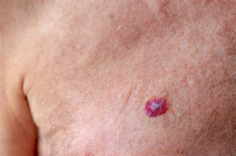 Is Basal Cell Carcinoma On The Rise Harley Street Dermatologists