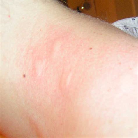 Images Of Bed Bug Bites On Black Skin Bed Bug Bites On The Skin