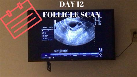 Day Follicle Scan Youtube