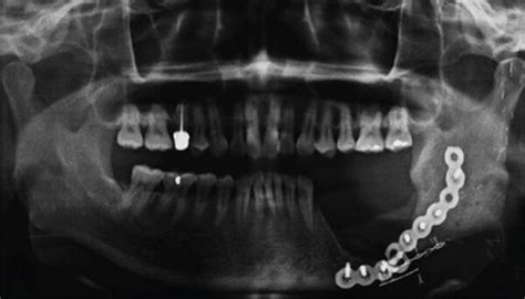 Panoramic Radiograph Demonstrated Huge Defect Of The Left Mandible Due