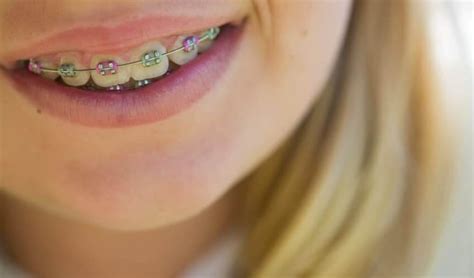 Convey More With Color What Colors Of Braces Should You Choose Myorthodontist