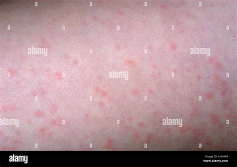 Viral Exanthem From Hand Foot And Mouth Disease Stock Photo Alamy