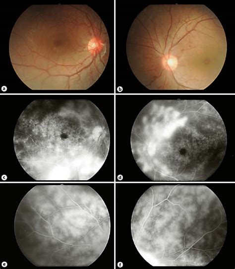 Fundus Photography And Fluorescein Angiogram On Initial Examination A