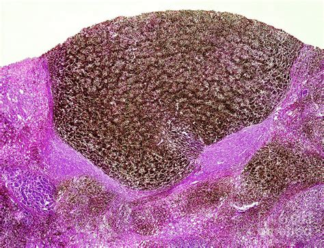 malignant melanoma of the human liver photograph by nigel downer science photo library fine