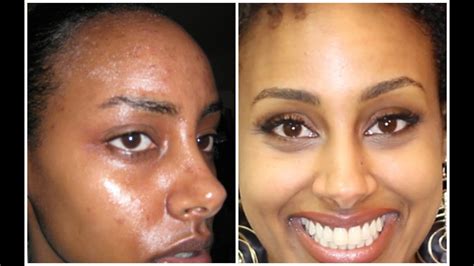 Secrets To Clear Skin Acne Before And After Youtube
