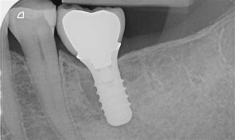 Implant Lower Molar Before And After Photos Garran Act
