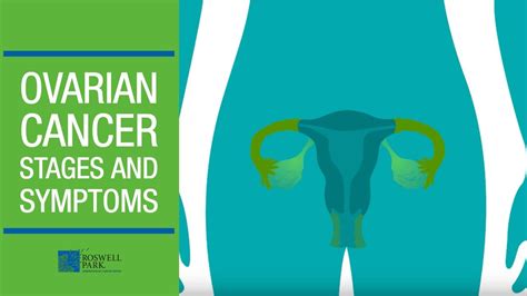 Understanding Ovarian Cancer Stages And Symptoms Youtube