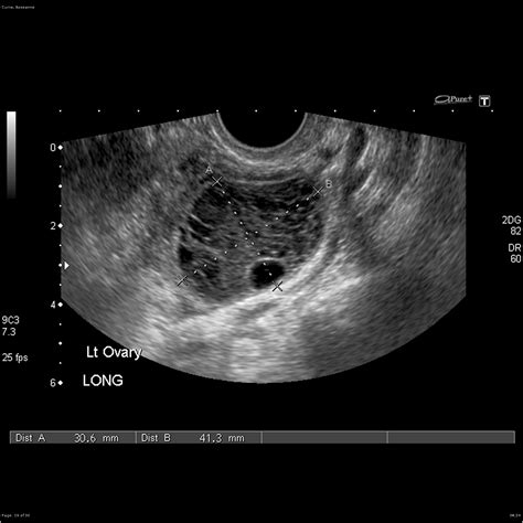 Exploring Sonograms For Ovarian Cysts Understanding The Role Of Obgyn