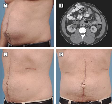 Abdominal Wall Reconstruction Lessons Learned From 200 Components