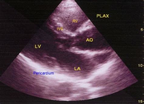 Parasternal Long Axis View In Echocardiography All About