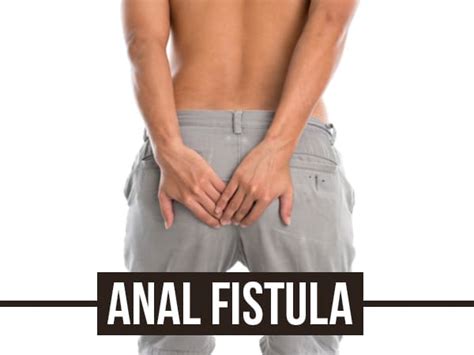 Anal Fistula Causes Risk Factors Symptoms Diagnosis Treatments And Prevention